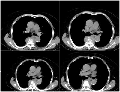 Case report: Thoracic vertebral abscess caused by Salmonella via diagnosed next-generation sequencing